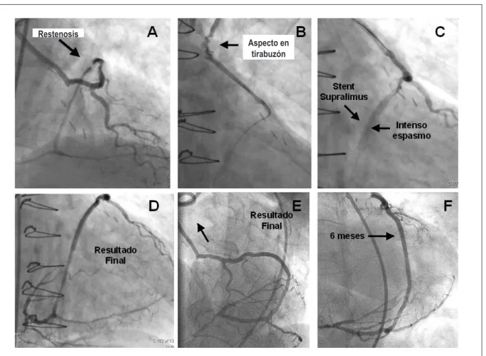 Fig. 2 -  A y B - Coronariografía en oblicua anterior izquierda y derecha, demostrando la restenosis en el injerto de la arteria radial (lechas)