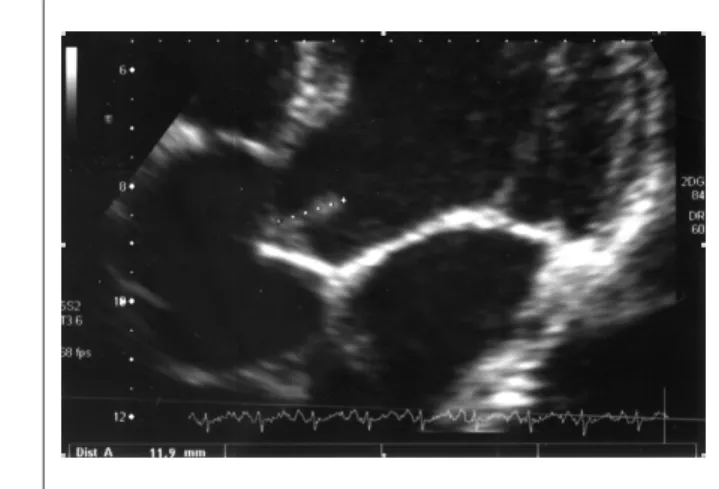 Figure 2 - Transthoracic echocardiography showing a thickened aortic valve  with a mobile, echogenic structure measuring 11 cm in its largest diameter