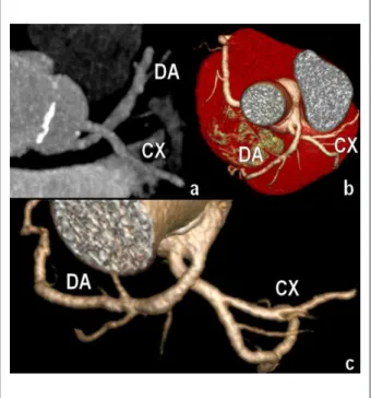 Fig.  1  - Imagem  oblíqua  em  MIP  (Maximum  Intensity  Projection)  (a)  e  reconstrução tridimensional (b, c) mostrando o trajeto das artérias coronárias