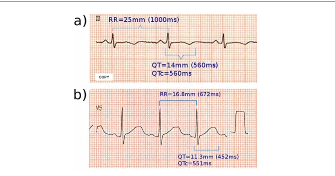 Figure 2 - Electrocardiograms of the probands of families A (patient A2.21) and B (patient B2.1).