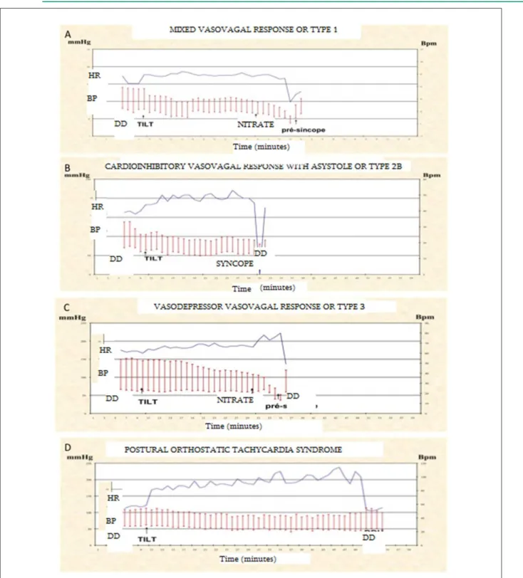 Figure 2 - Charts showing the behavior of BP and HR during different vasovagal responses and SPOT