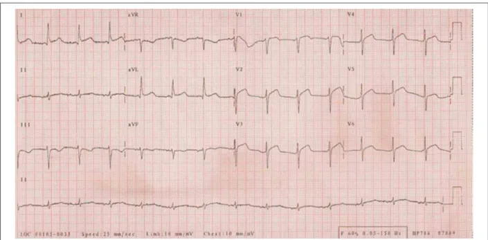 Figure 1 - ECG – sinus rhythm; ST-segment elevation from V 1  to V 6  and I and aVL, with positive T waves, suggestive of evolving extensive anterior acute infarction