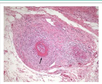 Figure  6  -  Histological  section  of  the  gallbladder  wall.  Intense  mixed  inlammatory process affecting all layers of the small arteries (pan-arteritis),  with thrombosis and vascular occlusion, in addition to ibrinoid necrosis of the  wall (arrow)