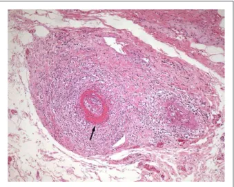 Figura 6 - Corte histológico de la  pared de la  vesícula biliar. Hay intenso  proceso inlamatorio mixto afectando todas las capas de pequeñas arterias  (panarteritis), con trombosis y oclusión vascular, además de necrosis ibrinoide  de la  pared (lecha)