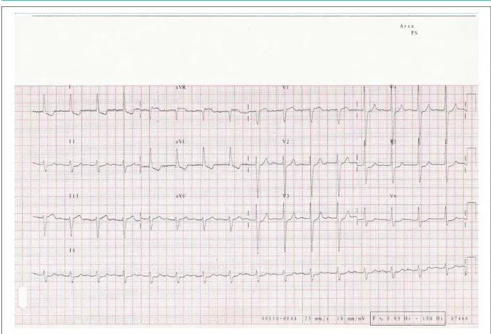 Fig. 1 - Electrocardiograma de reposo mostrando ritmo sinusal, bloqueo atrioventricular de 1° grado y sobrecarga ventricular izquierda.