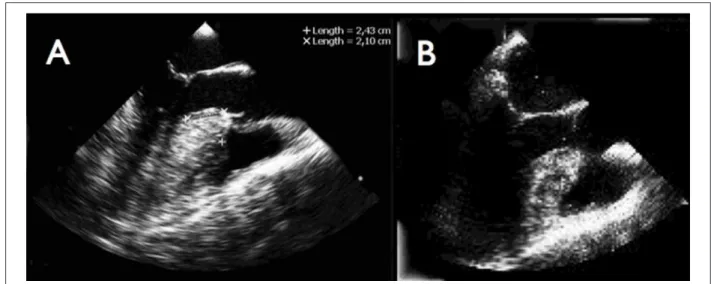 Figure 2 - Image of EPLV with color Doppler by transesophageal echocardiogram at the medium esophagus level with 120○ angle and challanging test wotj isoproterenol