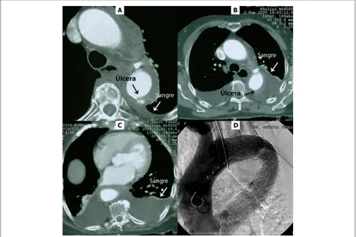 Figura 2 -  A: TC de tórax al ingreso que revela úlcera penetrante y derrame pleural a la izquierda, B y C: TC de tórax en el 10 º día después de la internación que  demuestra progresión del hematoma y extenso derrame pleural bilateral; y D: aortografía de