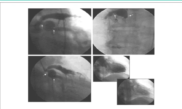 Figure 2 - Images of postoperative coronary angiography showing aortocoronary grafts, exclusion of aneurysm and left ventriculography.
