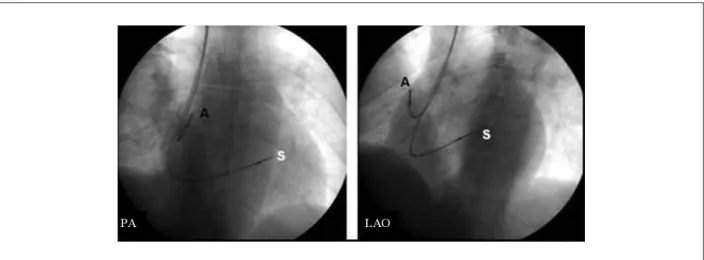 Figure 3 -  Radioscopic image in right anterior oblique (RAO) view at 10º in the image on the left