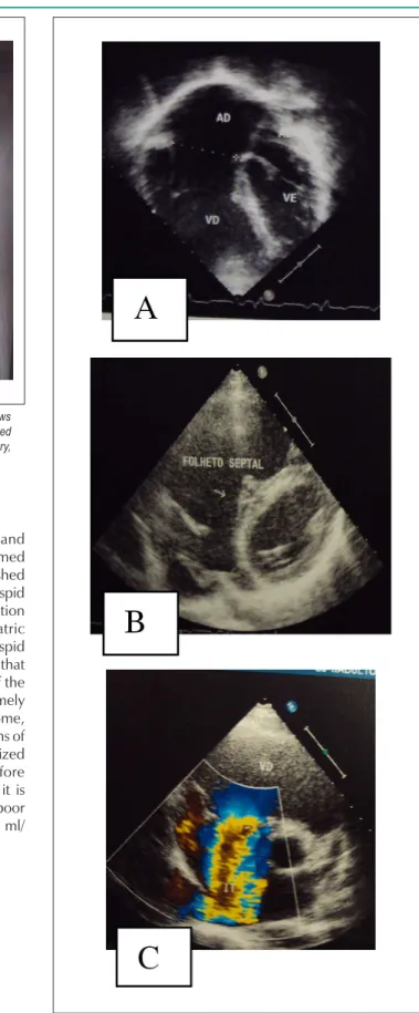 Figure  2  - Echocardiogram  shows  a  sharp  increase  of  the  right  cavities  in  4-chamber apical section, in A, the septal tricuspid valve was not very mobile  and  “attached”  to  the  ventricular  septum  without  coaptation  with  the  other  valv