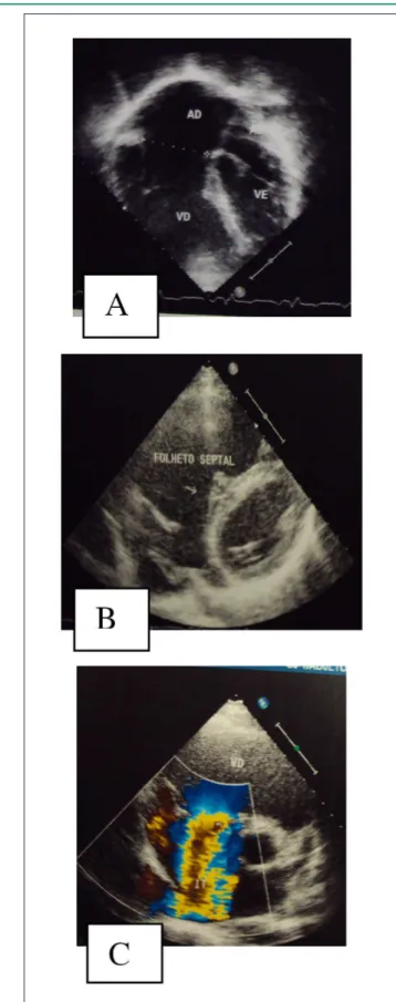 Fig. 1 - Radiografía de tórax en período post operatorio inmediato muestra  acentuado aumento de las cavidades derechas, arco medio escavado y trama  vascular  pulmonar  disminuida,  como  la  del  pre  operatorio,  sugestiva  de  la  anomalía de Ebstein.