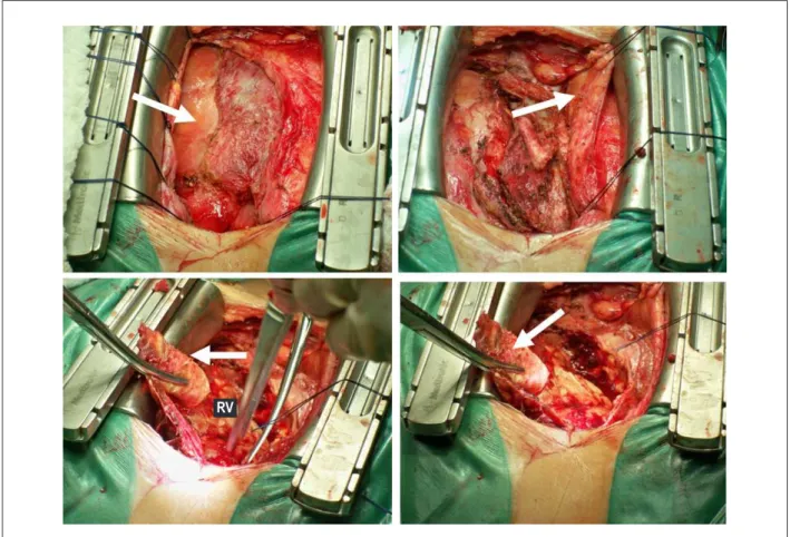 Figure 2 - Surgical aspect. The arrows indicate the calciied and thickened pericardium