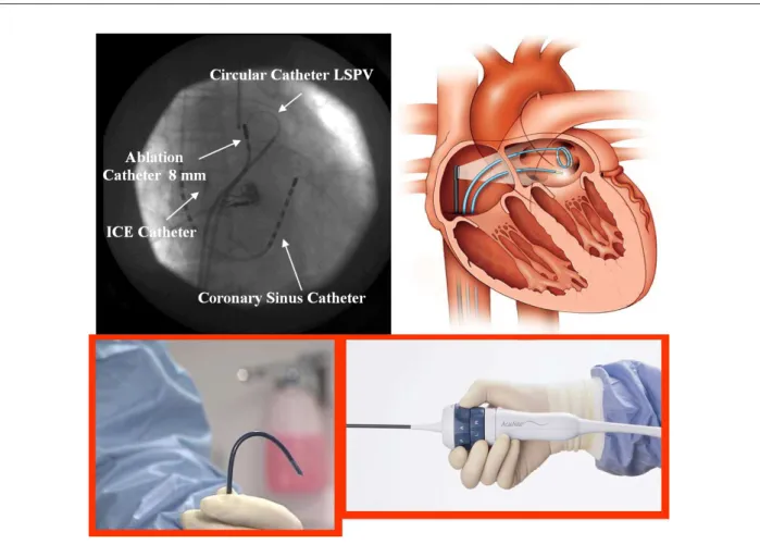 Table 1 - Use of the intracardiac echocardiography in cardiac  arrhythmias