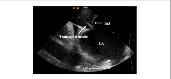 Figure 3 - Transseptal puncture carried out under direct visualization of the interatrial septum (IAS) through intracardiac echocardiography