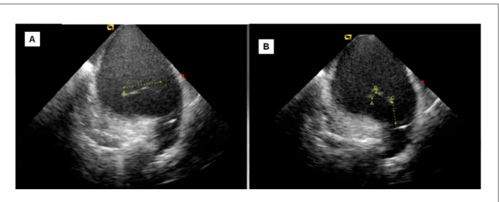 Figure 5 - Intracardiac echocardiographic images showing thrombus in the left atrium (yellow-dotted line), adhered to the circular decapolar catheter (Lasso™) located  in the left upper pulmonary vein.