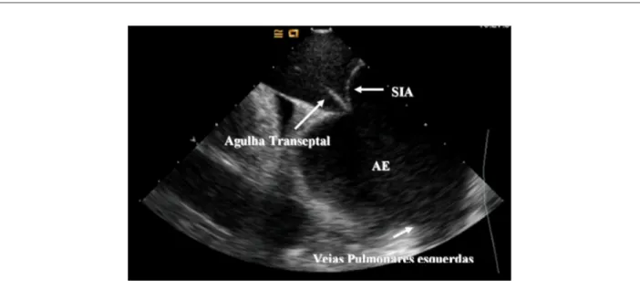 Fig. 3 - Realización de punción transeptal bajo visualización directa del septo interatrial (SIA) a través del ecocardiograma intracardíaco