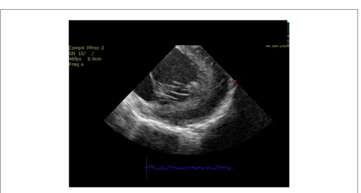 Tabla 2 - Estructuras/imágenes visualizadas por el ecocardiograma  intracardíaco útiles para electroisiología