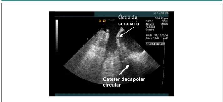 Fig. 6 - Visualización del ostio de arterias coronarias durante ablación de extrasístole ventricular en cúspide aórtica.