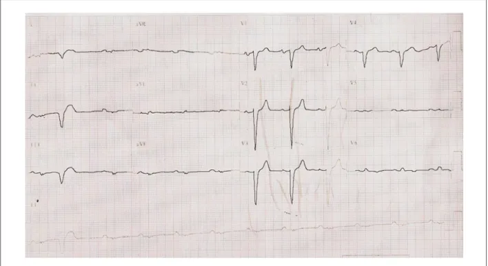 Fig. 1 –  ECG. Ritmo sinusal, BAV 1º grau, distúrbio da condução intraventricular do estímulo, tipo bloqueio de ramo esquerdo e sobrecarga de câmaras esquerdas.