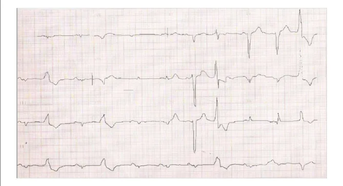 Fig. 2 –  ECG. Bradicardia sinusal, distúrbio da condução intraventricular do estímulo, tipo bloqueio de ramo esquerdo e sobrecarga de câmaras esquerdas.
