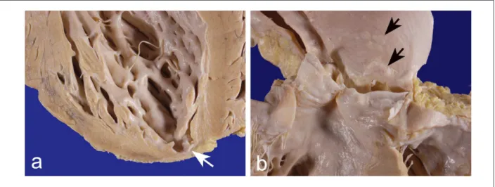 Fig. 3 –  Detalhes macroscópicos do coração e aorta. Em a nota-se ailamento do miocárdio no ápice ventricular (seta branca) e em b as placas de ateroma não  complicadas acima do plano valvar aórtico (setas pretas).