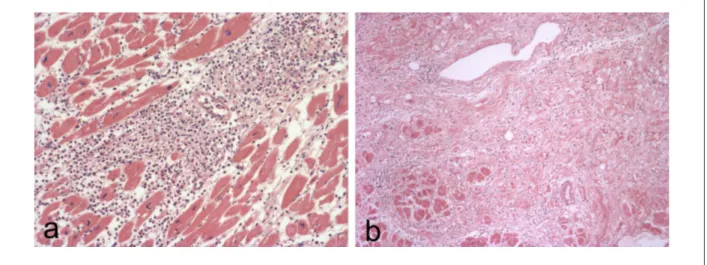 Figure 4 -  Photomicrographs of the myocardium showing a) severe chronic myocarditis and in b) diffuse ibrosis