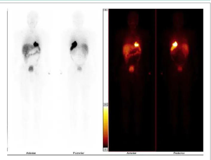 Figure 2 -  Total body scintigraphy in the anterior and posterior views, with BMMC labeled with 99mTc- HMPAO, showing the distribution of these cells in the heart,  lungs and hematopoietic organs.