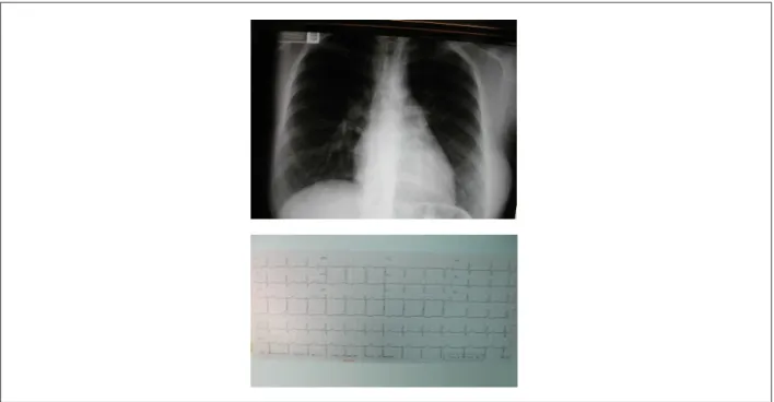 Fig. 2 -  Cineangiocoronariograia mostra artéria coronária direita dilatada anastomosando-se por intensa circulação colateral (setas) com a artéria coronária esquerda  também dilatada, e esta em conexão com o tronco pulmonar