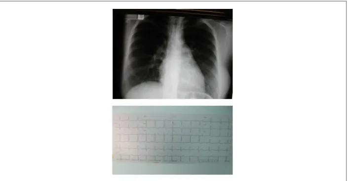 Figure 2 -  Coronary angiography shows dilated right coronary artery anastomosing by an intense collateral circulation (arrows) with the left coronary artery also dilated,  and this in connection with the pulmonary trunk