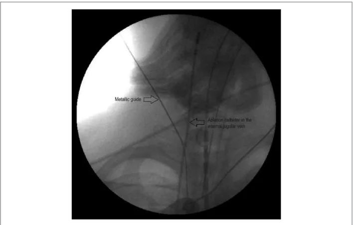 Figure 1 –  Puncture of the right internal jugular vein under luoroscopic vision. The ablation catheter is introduced from the right femoral vein to the right jugular vein,  serving as a luoroscopic marker, reducing the likelihood of an accidental puncture
