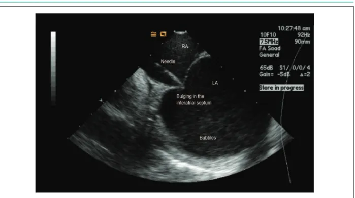 Figure 2 –  Intracardiac echocardiography-guided transseptal puncture. The transseptal puncture needle is placed exactly in the thin portion of the interatrial septum  (fossa ovalis) through the right atrium (RA); when pressing, tenting of the septum is cl