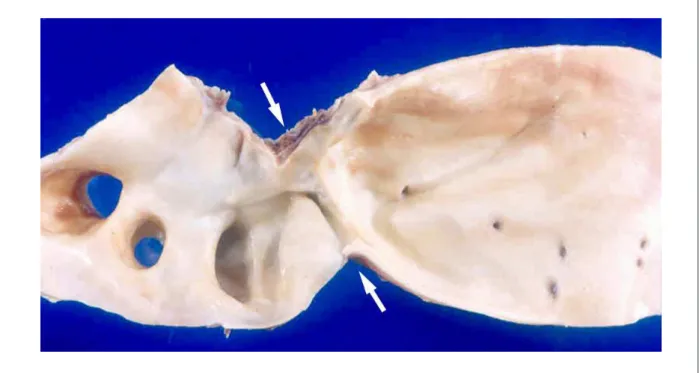 Figure 6 –  Localized narrowing of the aortic lumen at the isthmus, characterizing coarctation of the aortic arch (between arrows).