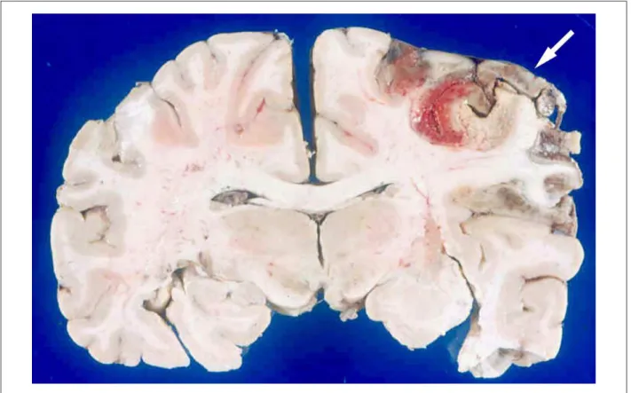 Figure 7 –  Extensive recent infarction of the right parietal region of the brain (arrow).