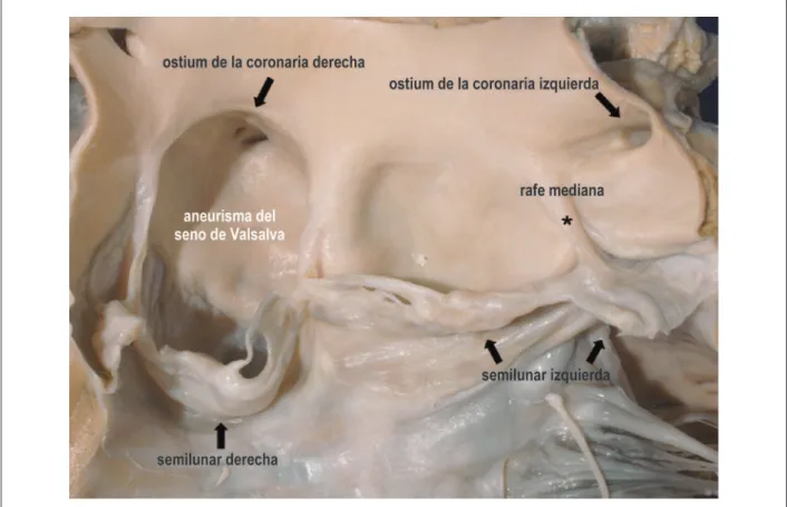 Figura 4 –  Aspecto macroscópico de la válvula aórtica bivalvulada y de la raíz de la aorta