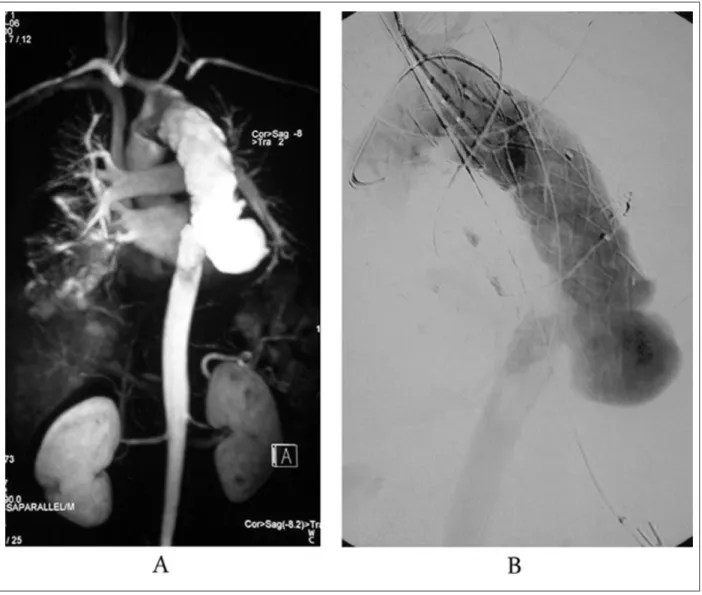 Fig. 1 -  A - Angiografía por tomografía computada mostrando previo tratamiento endovascular con endoprótesis vascular para aneurisma micótico sacular  del arco aórtico y la ruptura de la aorta descendente a partir del margen distal de la endoprótesis