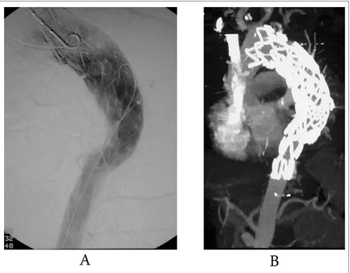 Fig. 2 –  A - Angiografía mostrando la exitosa  reparación de la ruptura aórtica a  través de la endoprótesis endovascular, anclando el cuerpo del nuevo sistema de  endoprótesis a la prótesis anteriormente implantada