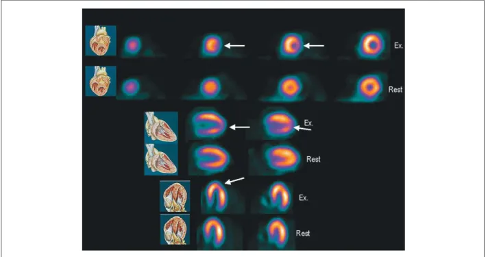 Figure 1 -  Dipyridamole sestamibi scintigraphy showing transitory defects in the lateral and anterior walls