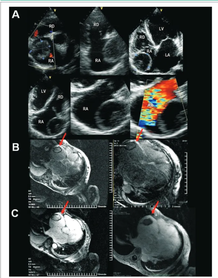 Figure 1  - A) TTE disclosing image of cystic aspect on the lateral wall of the right atrium (RA)