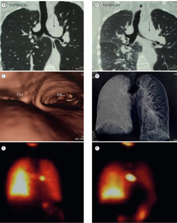 Figura 1 - TC com multidetectores de tórax com reconstrução coronal em inspiração (A), em expiração B),  endobrônquica (C) e com reconstrução volumétrica ao final da expiração mostrando aprisionamento aéreo  no pulmão esquerdo (D); e cintilografia pulmonar