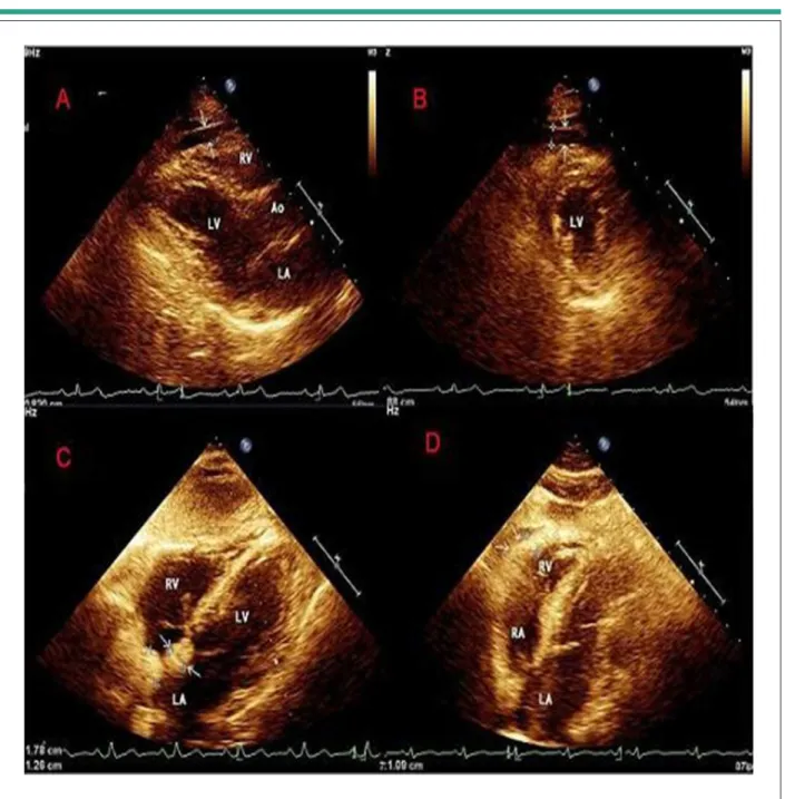 Figure 1 -  Echocardiographic evaluation of cardiac fat deposition parameters. A) Parasternal long-axis view using the aortic annulus as anatomic reference