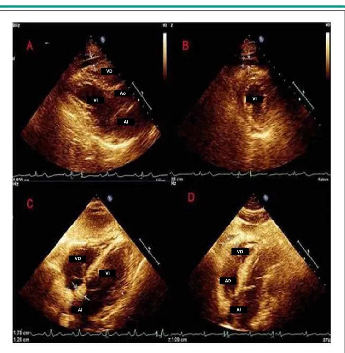Fig. 1 - Evaluación ecocardiográica de los parámetros de deposición de grasa epicárdica