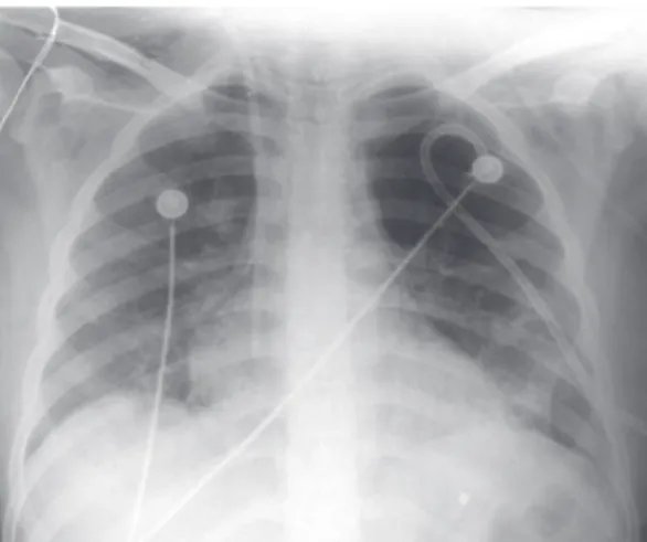 Figura 3 - Radiografia de tórax após melhora clínica 