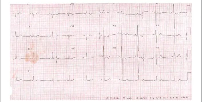 Figure 1 -  ECG: left atrial overload and probable left ventricular overload.