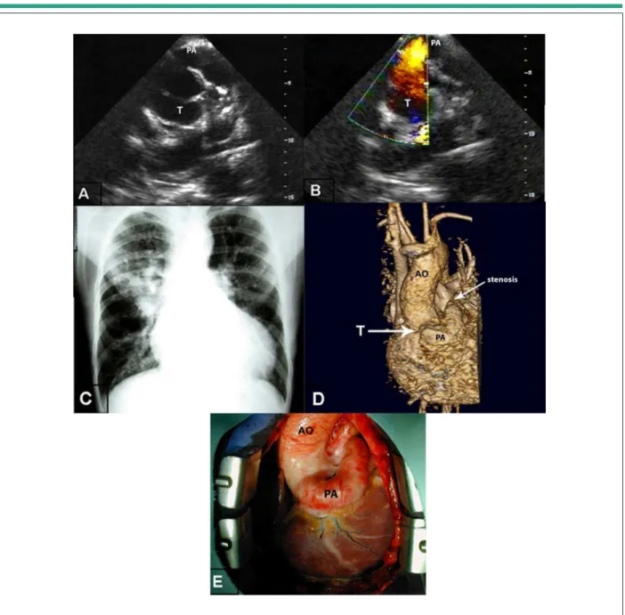Figure 1 - A) Echocardiography showing pulmonary artery emerging from the anterior portion of the common arterial trunk; B) Flow in red indicating the left-right direction  of the low, from the truncus into the pulmonary artery; C) Radiographic image showi