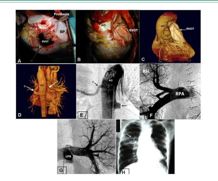 Figure 2 - A) Heart during surgery with right ventricle open, visible bioprosthesis and bovine pericardium which was used in the reconstruction of right ventricle outlow  tract; B) Final aspect of the right ventricle outlow tract reconstruction surgery, al