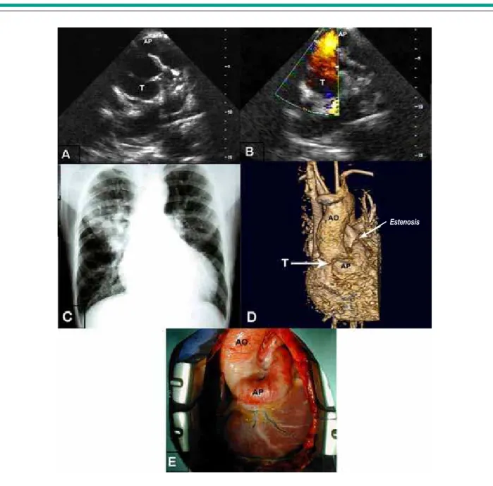 Fig. 1 - A) Echocardiography showing pulmonary artery emerging from the anterior portion of the common arterial trunk; B) Flow in red indicating the left-right direction  of the low, from the truncus into the pulmonary artery; C) Radiographic image showing