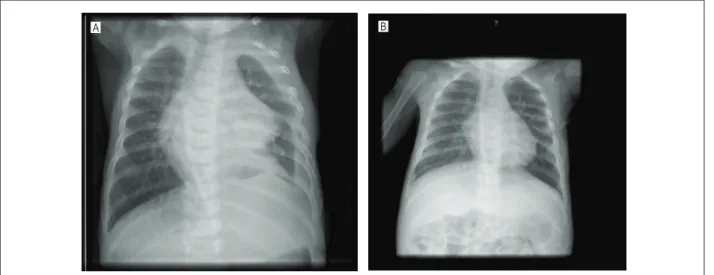 Figure 1 - A: Chest X-ray of J.M.U.S. on July 12, 2008. B: Chest X-ray of J.M.U.S. on August 25, 2008.