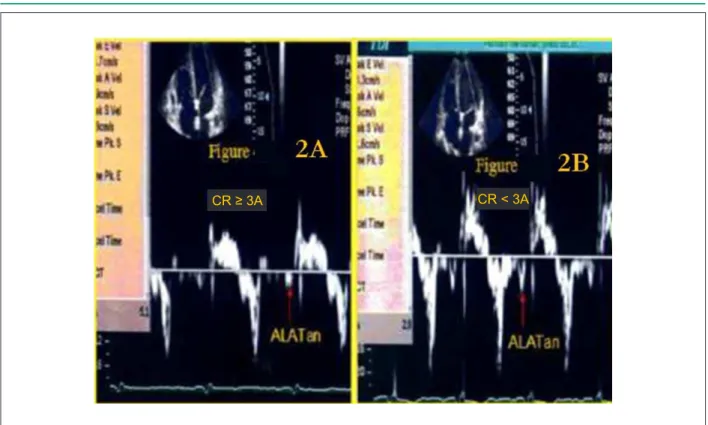 Fig. 2 -  Consecutive TDI studies in a patient with acute cellular rejection (CR ≥ 3A)