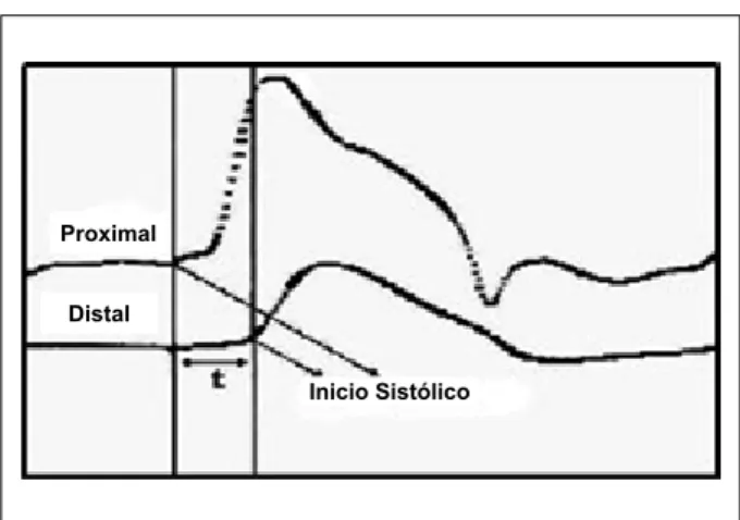Fig. 1 -  Mensuración de la velocidad de la onda de pulso (VOP). VOP - distancia  entre los sitios de comprobación proximal y distal, dividido entre el tiempo de  tránsito (t) entre los inicios sistólicos de las ondas de pulso.