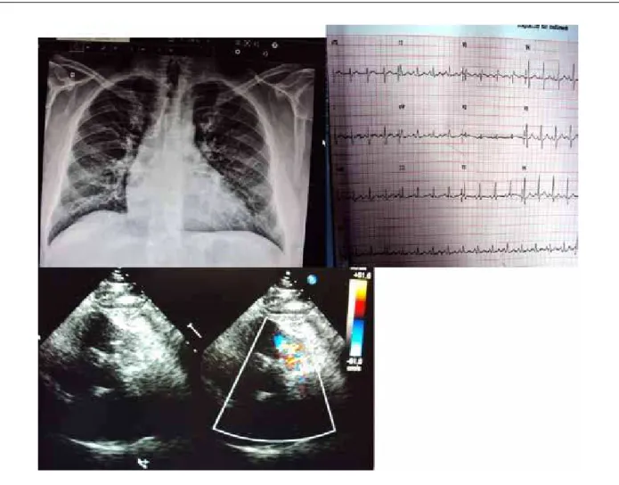 Fig. 2 - Angiograia mostra o ventrículo esquerdo (VE) normal em conexão com a aorta (Ao) em A, o aumento discreto do ventrículo direito (VD) com hipertroia miocárdica  e estenose pulmonar a nível valvar, em B